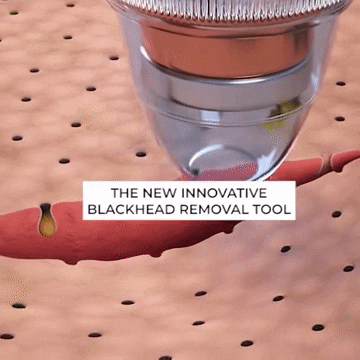 Electric Blackhead Remover β Suction Pore Cleaner & Beauty Tool